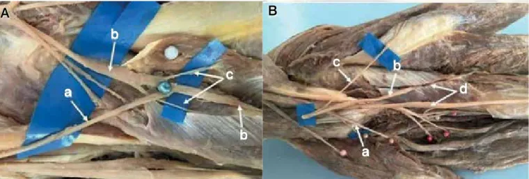 Figure 5. A. In 12 limbs we were able to connect the branch leading to the flexor carpi radialis (a) to the interosseous nerve (b), distally to the branches  to the supinator muscle (c) without tension, even during forearm pronosupination and elbow flexion