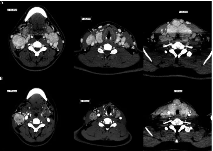 Figure 1. (A) Initial CT scans revealing thyroid enlargement with tracheal stenosis and bilateral conglomerates of cervical lymph nodes with compression  of adjacent structures