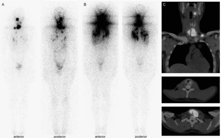 Figure 3. (A) Diagnostic whole-body scan after 3 months of adjuvant external beam radiotherapy