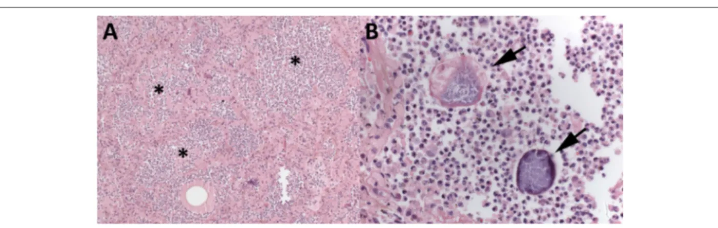 Figure 5 – Lungs (A and B). Aspiration pneumonia: alveolar spaces filled with dense suppurative neutrophilic inflammatory infiltrate (*), amid which, particulate food  material and filamentous bacterial aggregates, morphologically compatible with Actinomyc