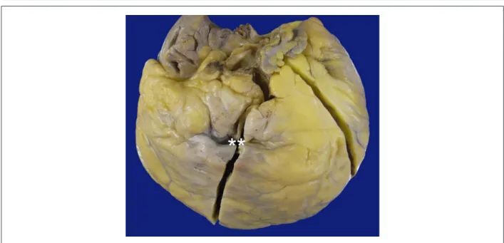 Figure 1 – External view of the anterior face of the explanted heart. The epicardial fat is abundant, and a collapsed aneurysmal formation can be seen in the right  ventricular outflow tract (asterisks).