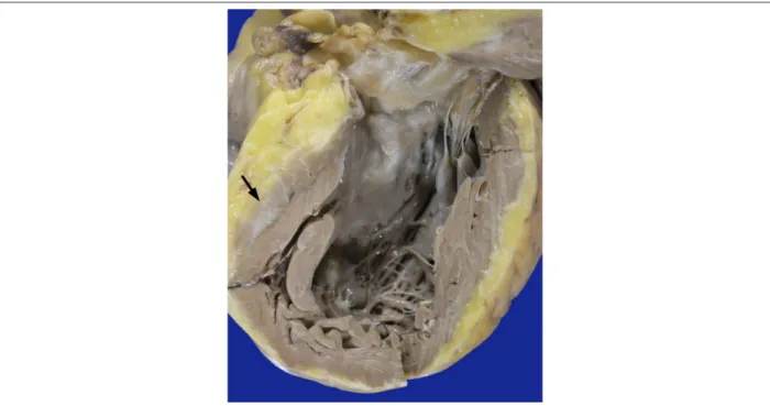 Figure 2 – Right ventricular inlet. The cavity is markedly dilated, and the fatty infiltration of the compacted portion of the wall is evident, remaining only the trabecular  musculature