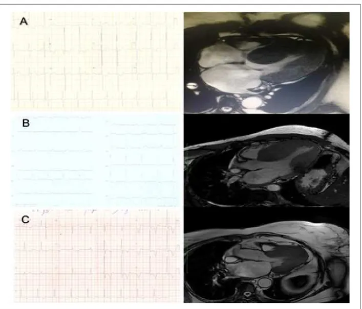 Figure 2 – A) E.D.S., male sex, 35 years. ECG: R wave in D1 of 35 mm, and R wave in V5 of 29 mm