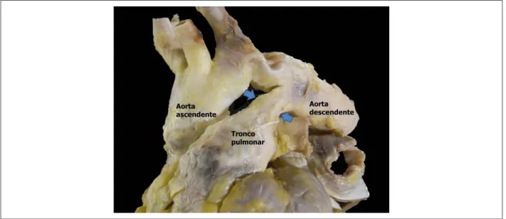 Figura 4 – Grandes vasos da base mostrando canal arterial persistente (entre as setas).
