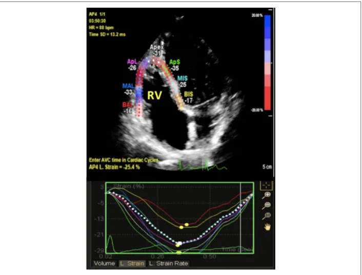 Figura 1 – Imagens bidimensionais representativas do strain ventricular direito. Corte apical de quatro câmaras pela técnica speckle tracking mostrando o strain longitudinal  global e regional do ventrículo direito