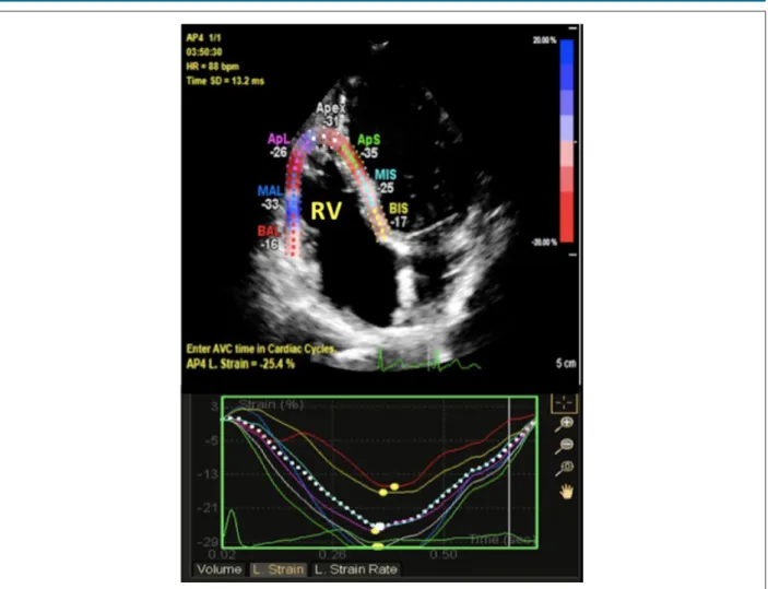 Figure 1 – Representative two-dimensional right ventricular strain images. Speckle-tracking apical four chamber view showing global and regional right ventricular  longitudinal strain