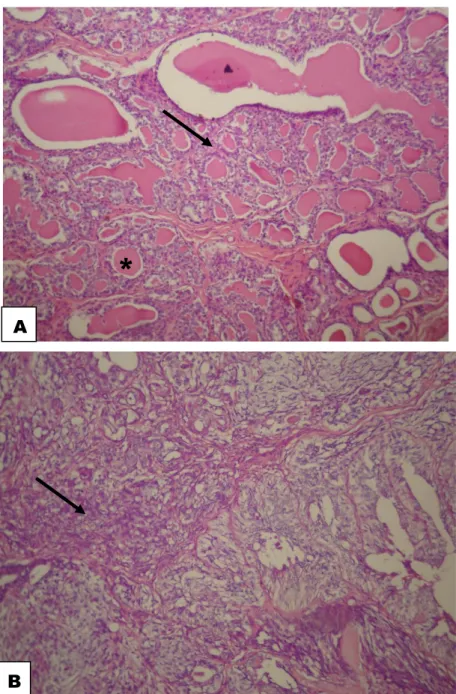 Figura 3.  A. Fotomicrografia de adenoma mamário de cadela. Notar proliferação de                       células epiteliais benignas formando túbulos (seta), com conteúdo róseo                      vítreo  no  interior  (*),  aumento  de  40x,  hematoxilina