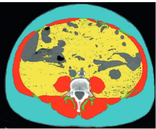 FIGURE 1  - Image example of CT on l3 level axial plane, analyzed  with sliceomatic®: the red color indicates the skeletal  muscle; green indicates the intramuscular adipose  tissue; yellow the visceral adipose tissue and the  blue the subcutaneous adipose