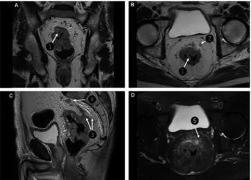 FIGURE 3 - Sagittal T2 sequences (A), T2 (B) coronal reconstructions,  sagittal (C) and axial T2 (D) demonstrating a vegetative  lesion that reduces its lumen (A, B and C - ❻ and  arrows) compromising all the layers of its wall