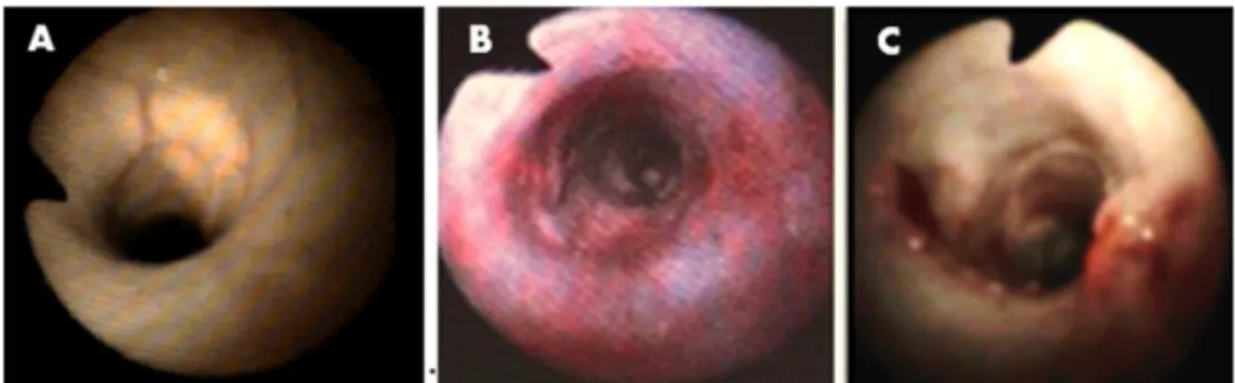 Figure 3 –  Colonoscopy in rats. Control/Sham group ( A ). Intense bleeding and hyperaemia seven days after  TNBS-induced colitis ( B )