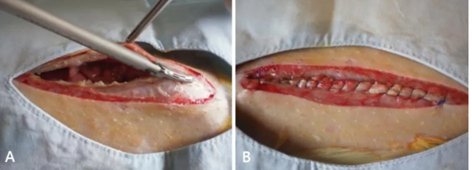 Figure 1  – Incision ( A ) with ultrasonic harmonic scalpel in the linea alba and continuous suture ( B ) for closing.
