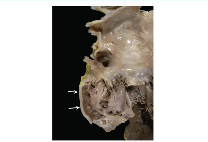 Figura 8 – Aspecto macroscópico da lesão afilada da parede lateral do ventrículo esquerdo, onde há substituição fibrosa do miocárdio (setas)