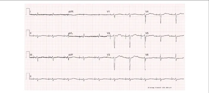 Figure 5 – ECG: operational pacemaker with atrial stimulus propagating normally to the ventricle.