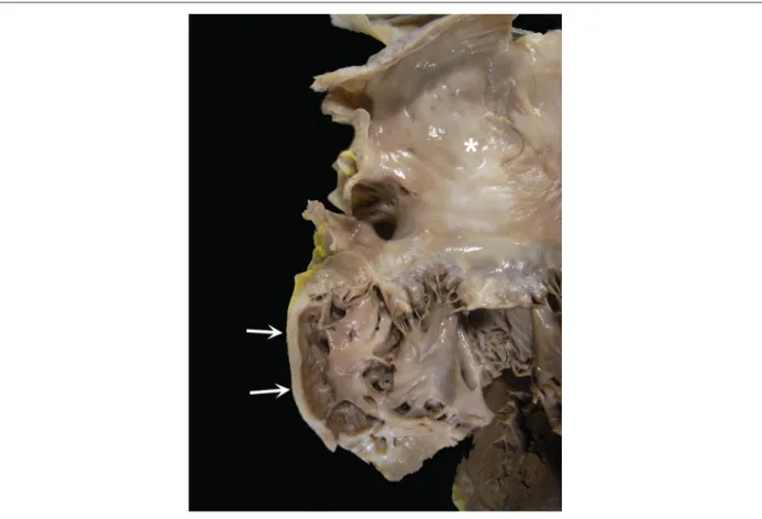 Figure 8 – Gross examination: aneurysmal thinning of the left ventricular lateral wall, with fibrous replacement of the myocardium (arrows)