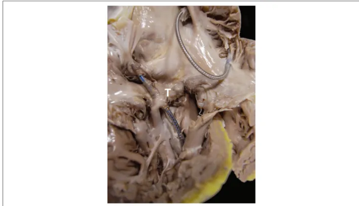 Figure 9 – Right chambers showing two endocardial pacemaker metallic leads, one attached to the atrium and the other to the ventricular apex