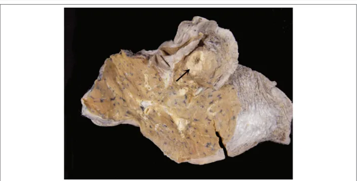 Figure 10 – Cut surface of the lung showing an ill-defined nodule with necrotic center (arrow).