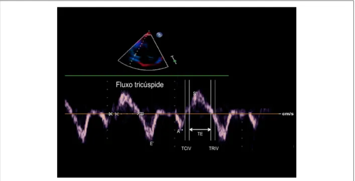 Figura 1 – Doppler tecidual do anel tricúspide em corte apical de quatro câmaras (E’ – pico da velocidade diastólica precoce do anel tricúspide; A’: pico da velocidade diastólica  tardia do anel tricúspide; S´: velocidade sistólica anular; TRIV: tempo de r