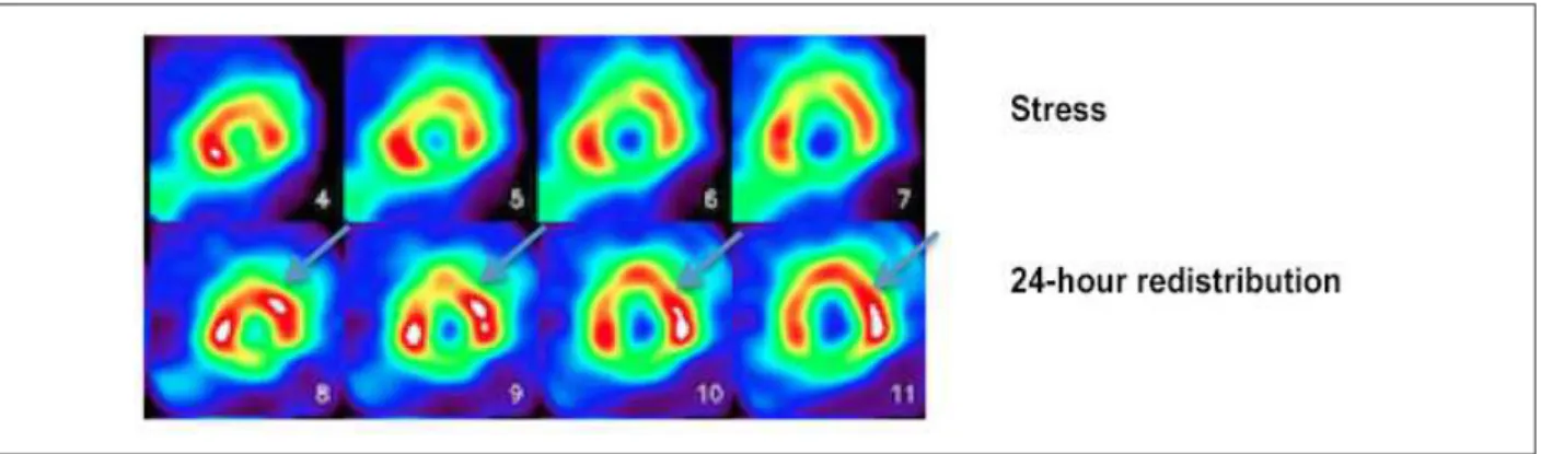 Figure 3 – Myocardial perfusion scintigraphy with  201 Tálio for assessment of myocardial viability; stress imaging (upper line) and 24-hour redistribution imaging after injection  of the radiotracer  201 Tálio (lower line), showing improvement of perfusio