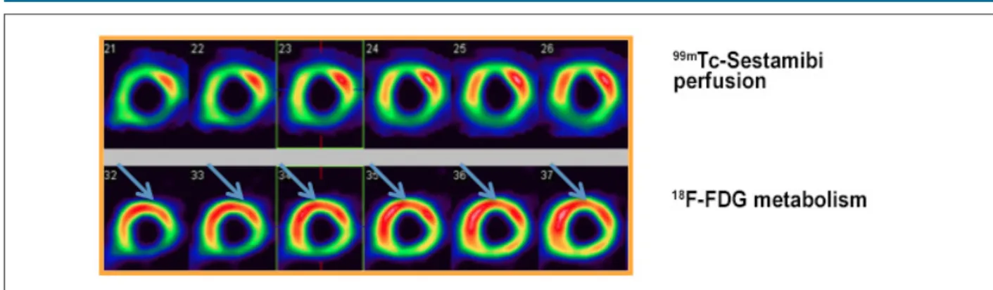 Figure 4 – Myocardial perfusion scintigraphy with  99m Tc-Sestamibi (upper line) and  18 F-FDG PET (lower line) for assessment of myocardial viability, showing improvement in  perfusion/metabolism in anterior (apical, medial and basal), apical septal, ante