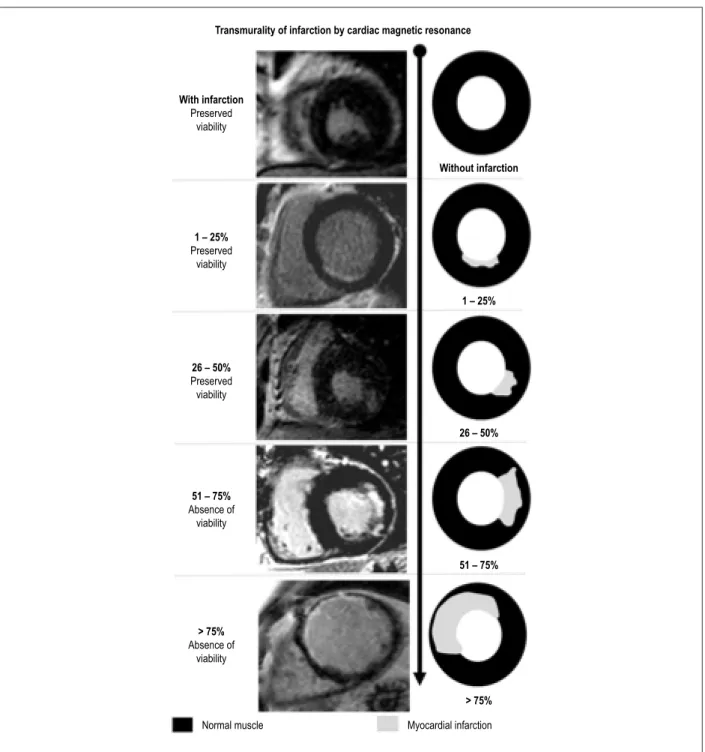 Figure 5 – Patterns of transmurality of infarction in the presence and absence of viability by cardiac magnetic resonanceTransmurality of infarction by cardiac magnetic resonance