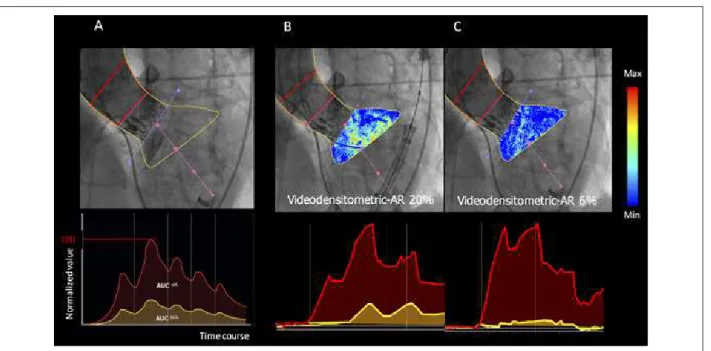 Figura 2 – Avaliação videodensitométrica da regurgitação aórtica. A) Delineamento da raiz aórtica (região de referência: área vermelha na aortografia) e do terço  sub-aórtico do ventrículo esquerdo (ROI, região de interesse: região em amarelo na aortografi