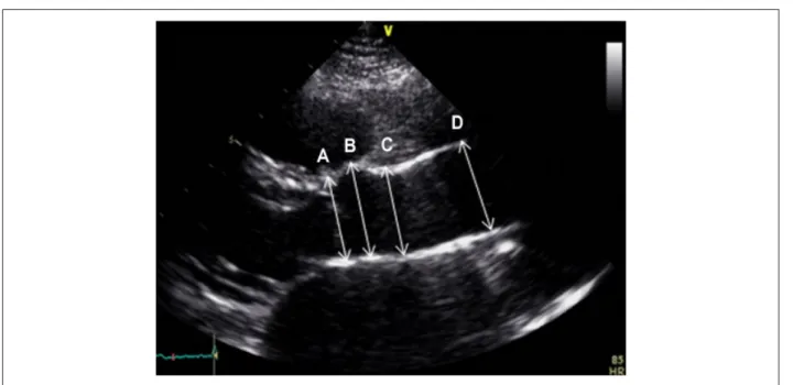 Figure 1 – Measurements of the aorta. Two-dimensional echocardiogram of the neo-aorta, parasternal view of the long axis of the left ventricle