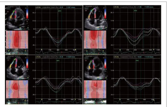 Figure 1 – Longitudinal peak systolic strain (ε) curve was obtained in right ventricular free wall for basal, middle and apical segment by 2D-STE from the apical four-chamber  view