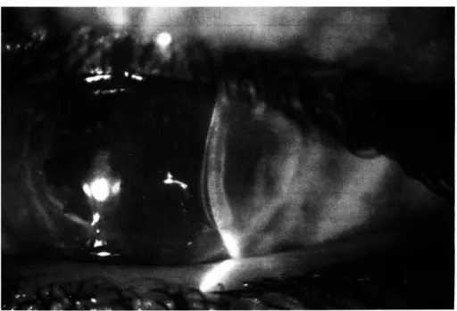 Fig.  2  - Enxerto transparente.  Caso  7. 