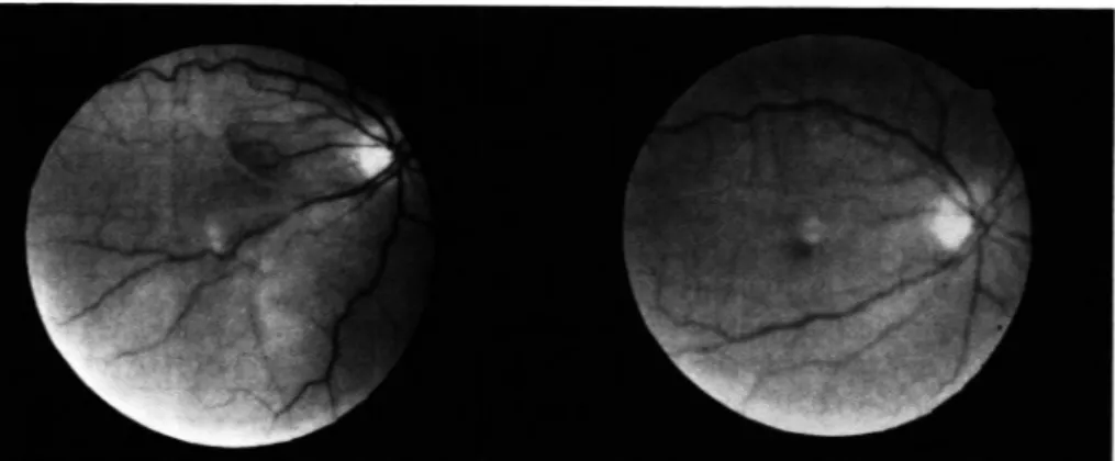 Figura  1  - Pucker macular assoçiado a ruptura de retina recente.À esquerda retinografia no pré-operatório; 