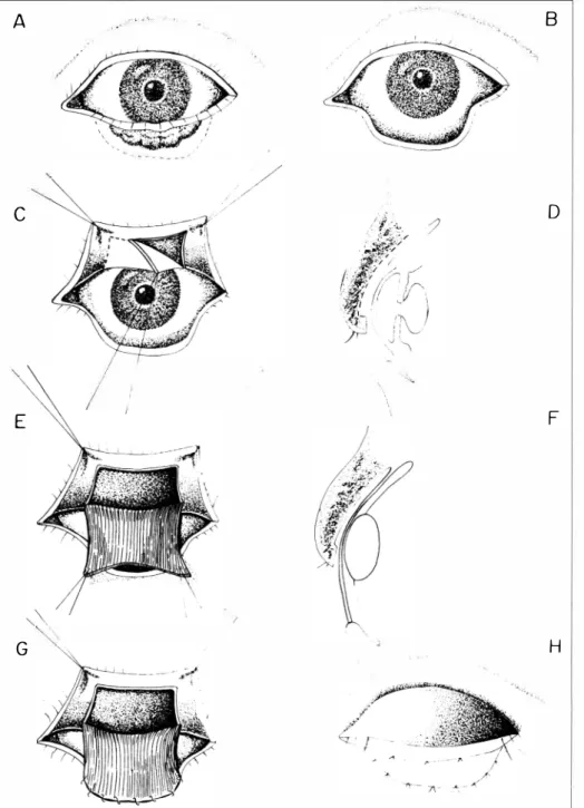 Figura - Técnica cirúrgica (Tempos A,  8,  C,  D,  E,  F,  G,  H) 