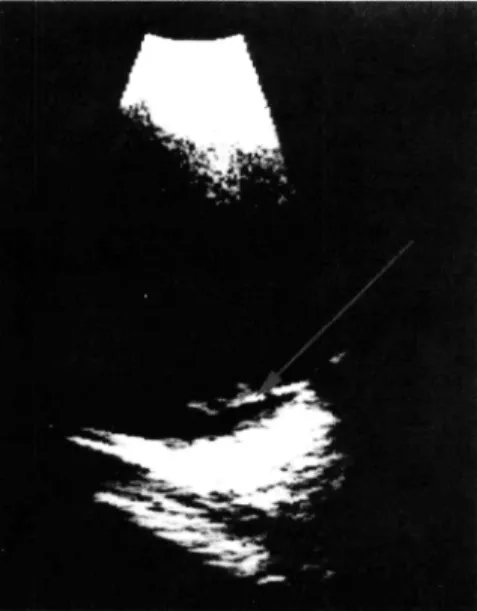 Fig.  1  - Olho  Esquerdo:  Ecografia  B  (caso  1 1 )   mostrando descolamento parcial do vítreo poste­