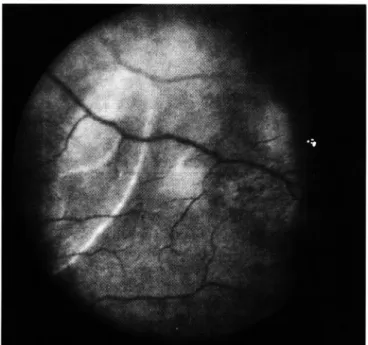 Fig.  3  - Olho  Esquerdo:  Retinografia,  pós-operatória,  mesmo  caso  da  figura  1  (caso  1 1  ),  mostrando  lesão  coriorretiniana  linear,  branca,  de  contorno oval , temporal à mácula