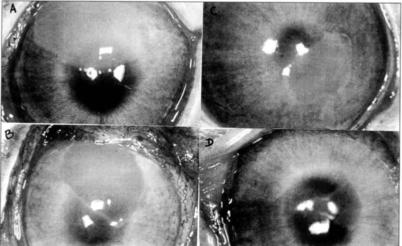 Table 2 shows the mean healing time for the 3  groups .  A  great variation, shown by  the  high standard error, occurred  in  Group  1 ,  due  probably  to  the  fact  that  healing  o f  the  epithelial defect of two eyes from this group took 3 1  and 2 