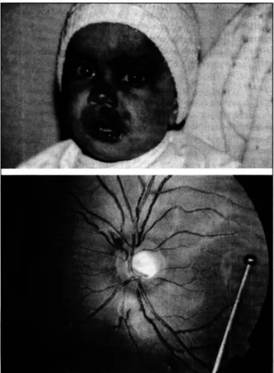 Fig.  1 .   A.  Fotografia  clín ica  de  criança  portadora  da  síndrome  de  Stu rge-Weber  com  hemangioma  de  hem iface  esquerda,  também  chamado  de  nevus  flammeus,  caracterizado  como  u m a   mancha  vermelho-arroxeada em hemiface