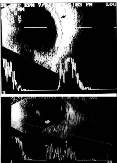 Fig. 2. A. Fotografia de exame de ultra-som em modo A e B conjugados,  mostrando  um  caso  de  hemangioma  difuso  de  coróide associado à  síndrome  de  Stu rge-We ber,  q u e   se  a p resenta  c o m o   á rea  de  espessamento difuso da coróide (seta) 