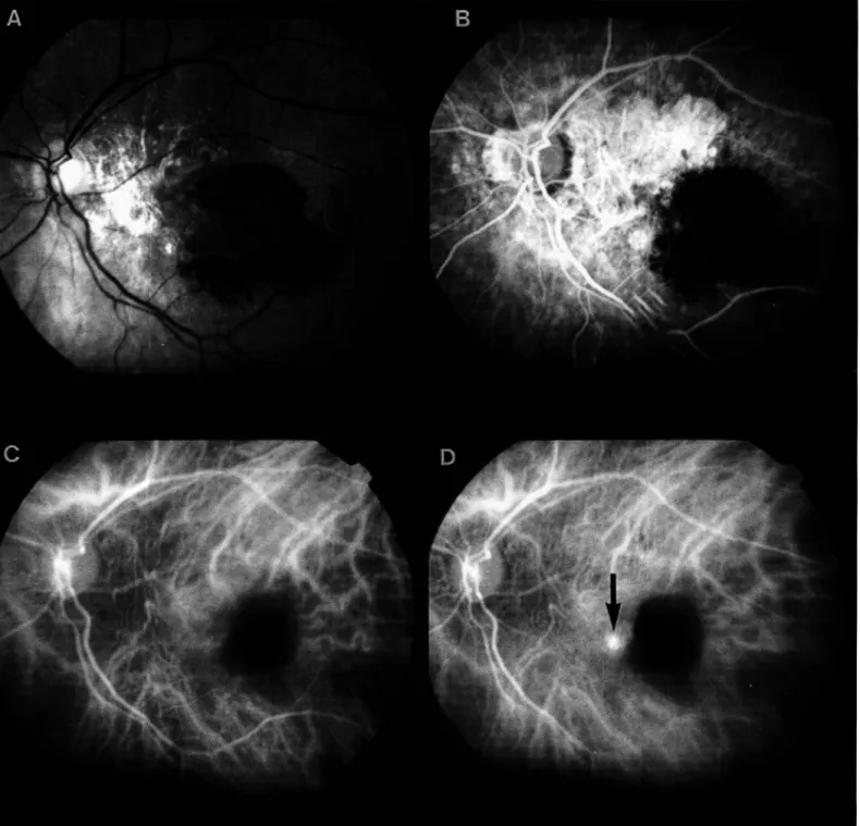 Fig. 1  - Retinografia com  membrana neovascular sub-retiniana em degeneração macular relacionada à idade, observando-se a  lesão tipo PONTO  FOCAL (seta) na angiograf!a digital com  i ndocianina verde