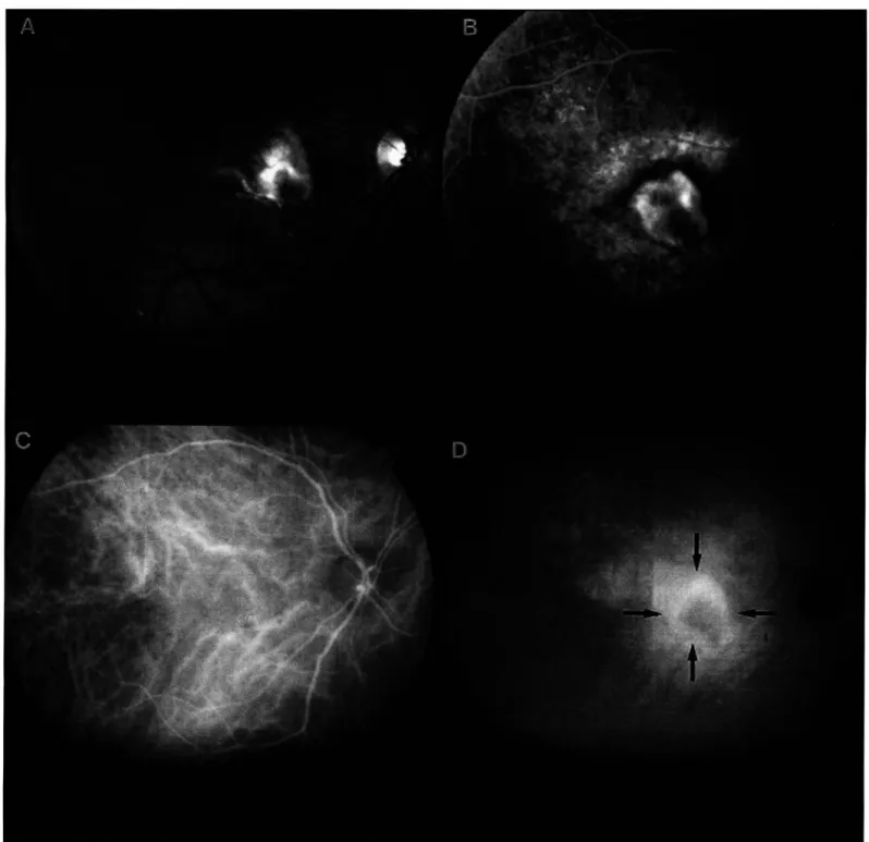 Fig. 2 - .  Retin�gr!'f ! a com �embr�n� neovascular sub-retiniana em degeneração macular relacionada à idade, observando-se a lesão tipo PLACA  na angrografra drgrtal com r ndocranrna verde