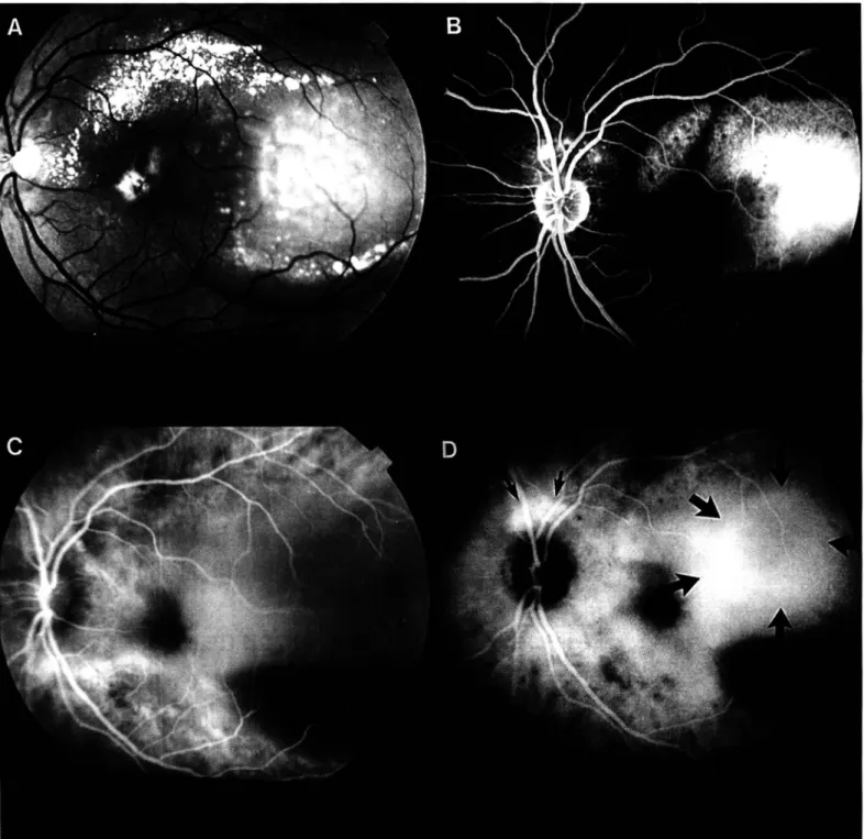 Fig.  4 - Retinografia com membrana neovascular sub-retiniana em degeneração  macular relacionada à  Idade,  observando-se a  lesão MISTA com  PONTOS REMOTOS (setas mais finas,  PONTO FOCAL; setas mais largas, PLACA) na angiografia digital com indocianina 