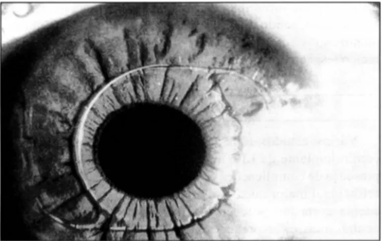 Fig  1 .  Fotog rafia  em  lâmpada  de  fenda demonstrando uma  lente de  câmara  anterior  para  correção  de alta  miopia  (lente  de  Baikoff)  bem  colocada,  podendo-se  verificar a  sua  porção  óptica  central izada  em  relação à pupila, local izad
