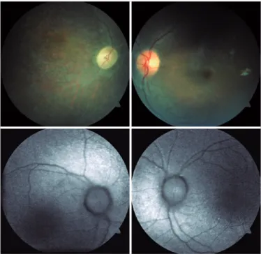 Figure 1. Representative images of cases: Top Left: Retinography of the  right eye showing optic disc pallor, narrowing of retinal vessels, and  pe-ripheral bone spicules; Top right: Retinography of the left eye showing  slight optic disc pallor and narrow