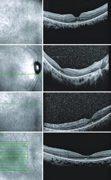 Figure 2. SD-OCT images showing a single layer of undifferentiated and  immature photoreceptors in the foveal area  outer retinal layer atro   -phy-ORLA- (yellow dot), and central retinal thinning-RT (blue dot).