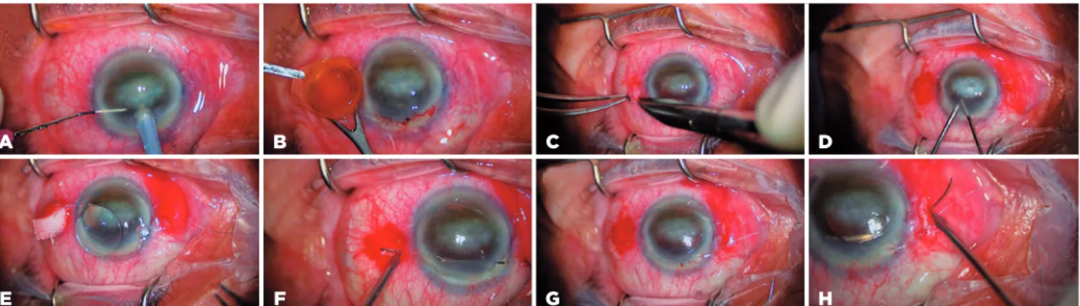 Figure 1. A-B) We planned phacoemulsification cataract surgery in this case. However, we performed extracapsular cataract extraction due to  posterior and anterior capsule deficiency during surgery