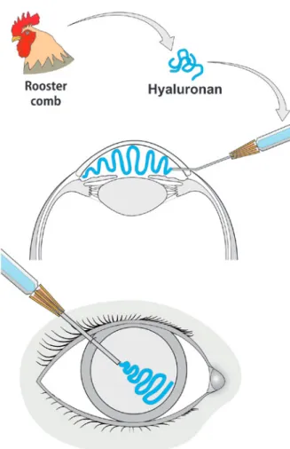 Figure 4. Viscosurgery, with hyaluronic acid acting to maintain the anterior  chamber and protect the endothelium (Dr