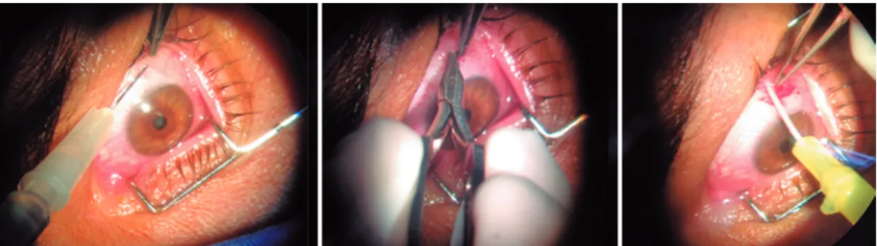 Figure 1. Sequence of sub-Tenon’s injection of triamcinolone: Subconjunctival anesthesia, opening of the bulbar conjunctiva,  and triamcinolone injection with the aid of a 24G Abbocath ®  cannula.