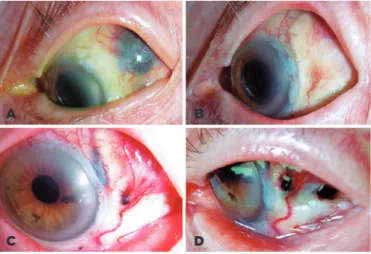 Figure 2. Clinical example of scleral necrosis (SNEC) treated by scleral  patch graft