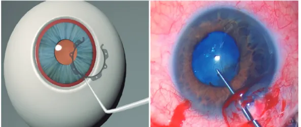Figure 2. Insertion of the second half of the Canabrava Ring into the eye with the help of a Sinskey Hook