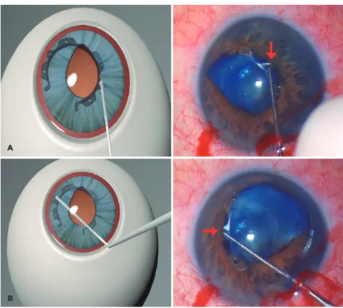 Figure 4. A and B) The process shown in figure 3 is repeated for each inferior indent.