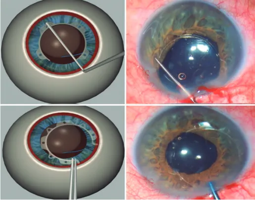 Figure 6. Ring removal from the iris with the Sinskey Hook and from the eye with McPherson Forceps.