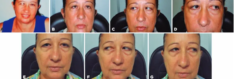 Figure 3. Patient identified as JJA in table 1. Pre-surgical angle of deviation= 100 ∆ 