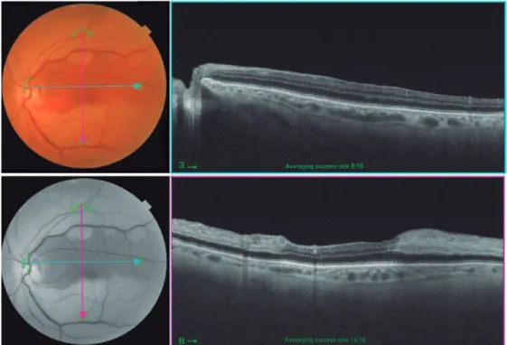 Figure 2. SS OCT with the horizontal line examination shows preserved retinal layers thickness (superior ima- ima-ge)